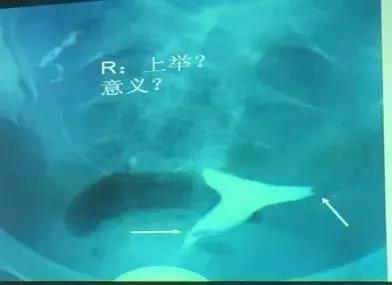 输卵管上举