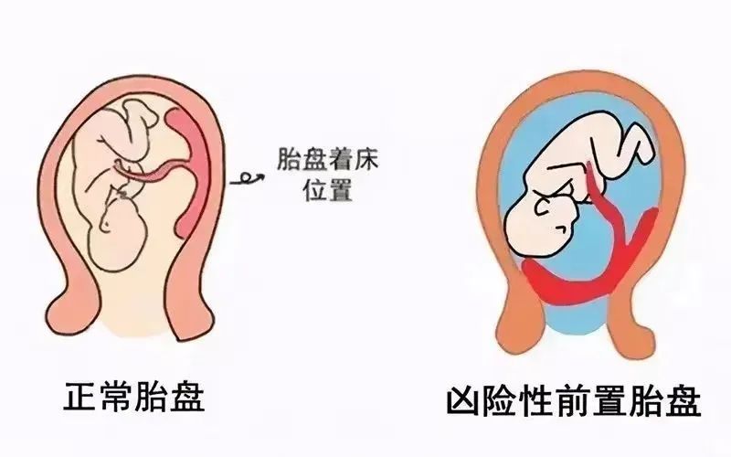 什么是凶险性前置胎盘