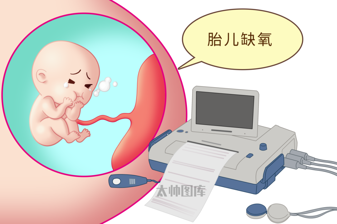 胎监就是医生的"透视眼"，能通过胎心监护能及时了解到胎动时、宫缩时胎心反应，推测胎儿有无缺氧、脐带绕颈、先天性心脏病、是否临产、是否需要剖宫产等
