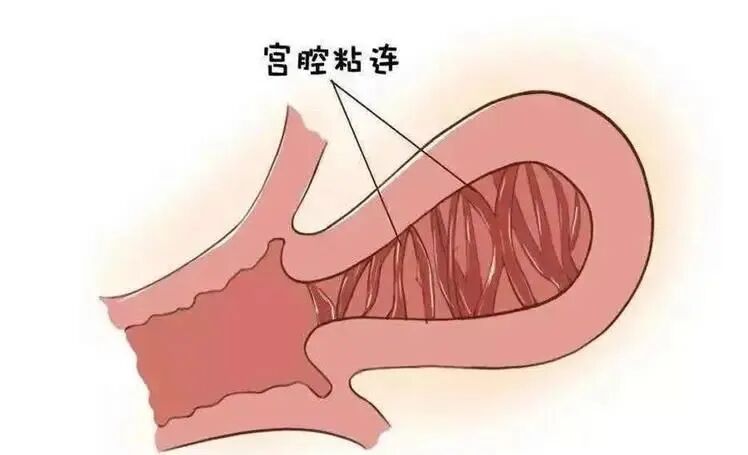 单纯的内膜薄厚问题还好,但如果合并有其他宫腔病变,比如宫腔粘连等,那么问题会棘手一点,移植成功率可能也会受到一定影响